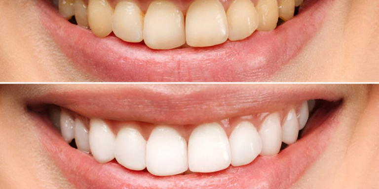 Brighten Your Life: The Importance of Teeth Whitening & Smile Enhancement